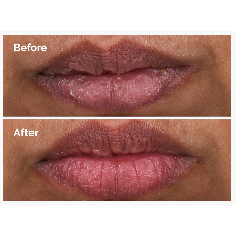 PHA 5% Exfoliating Lip Serum, 15ml